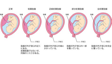 前置胎盤原因|前置胎盤について